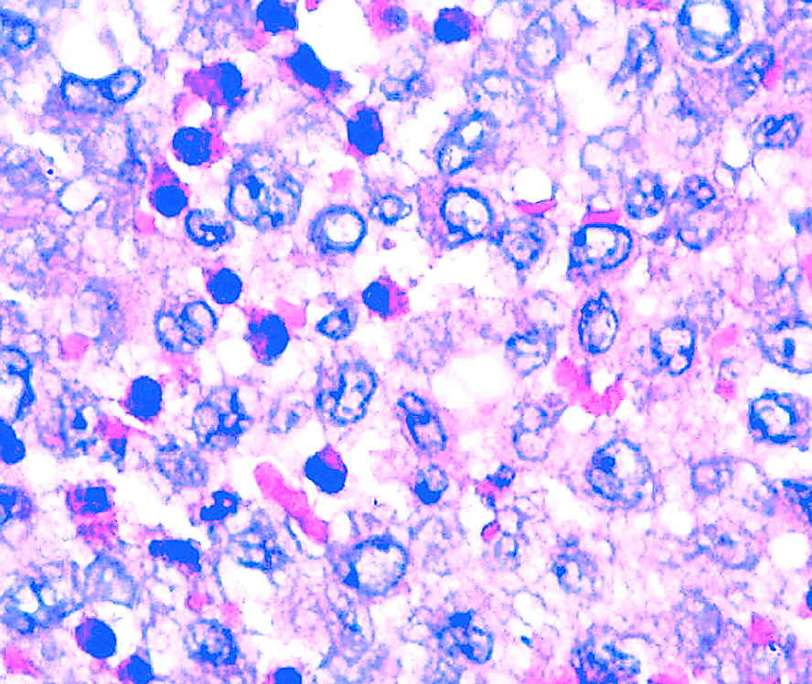 Pulmonary Langerhans Cell Histiocytosis Histology Cloudshareinfo